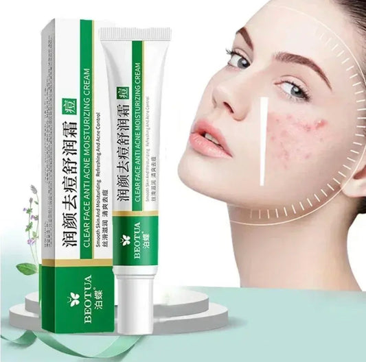 Sets of 3 Natural Face Moisturizing Cream, Acne Treatment, Scar and Blackhead Remover, Pore Minimizing, 30 g