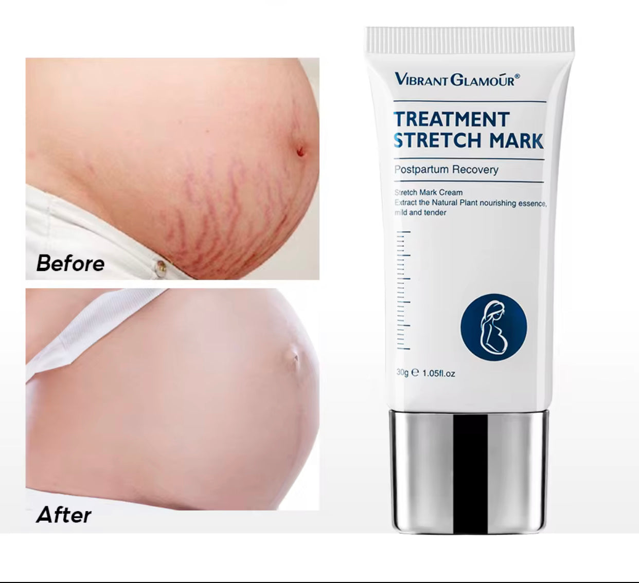 Sets of 10 Vibrant Glamour Treatment Stretch Mark Cream, 30g, Postpartum Recovery, Natural Plant Nourishing Essence